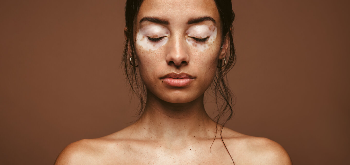 White Spot (Vitiligo) Treatment